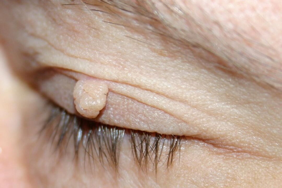 sintomas sa papilloma sa eyelid